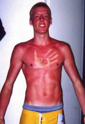 Nice Sunburn picture