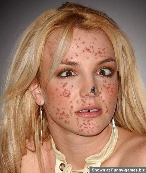 Britney Acne picture